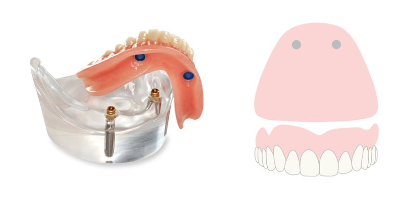 dc_imp_overddenture_abutments