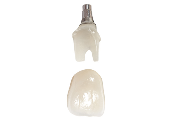 implantcrowns_cement Cement Implant Crowns