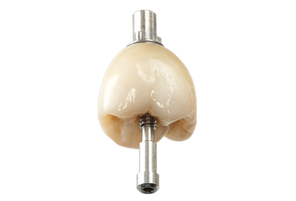 implantcrowns_screwocclusal Implant Crowns Screw Occusa