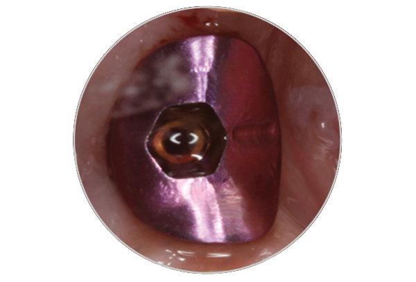 Milled titanium