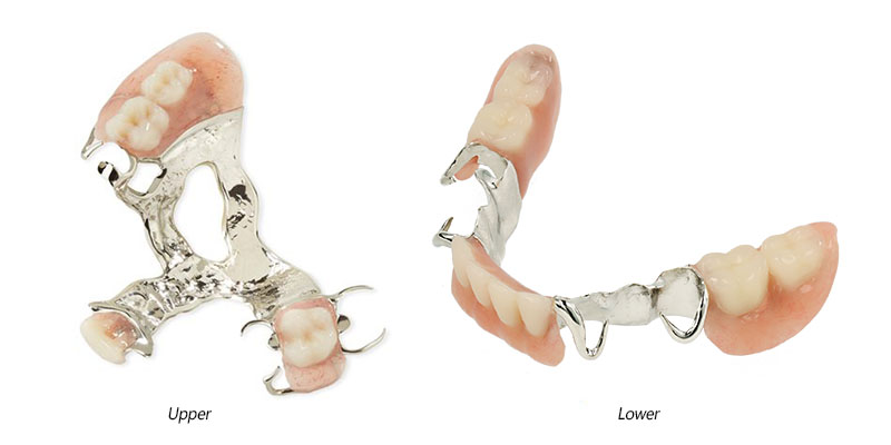Cast Frame Removable Partial Dentures