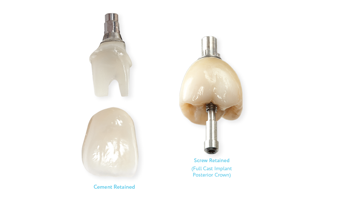 Implant Crowns