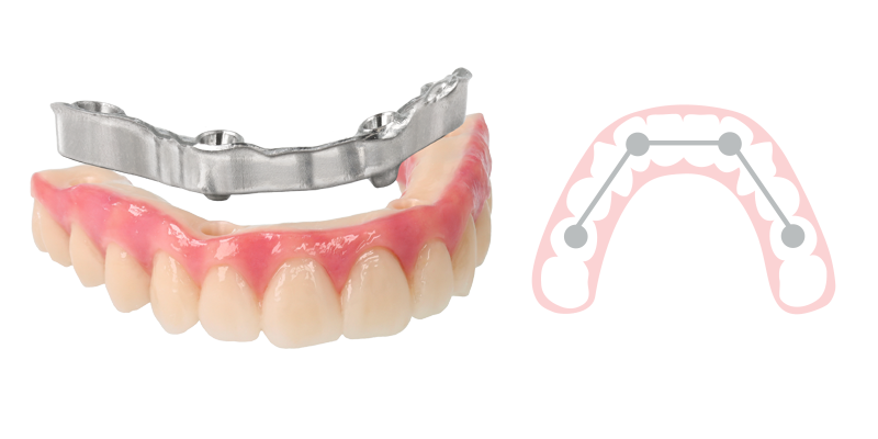 Zirconia Hybrid with bar