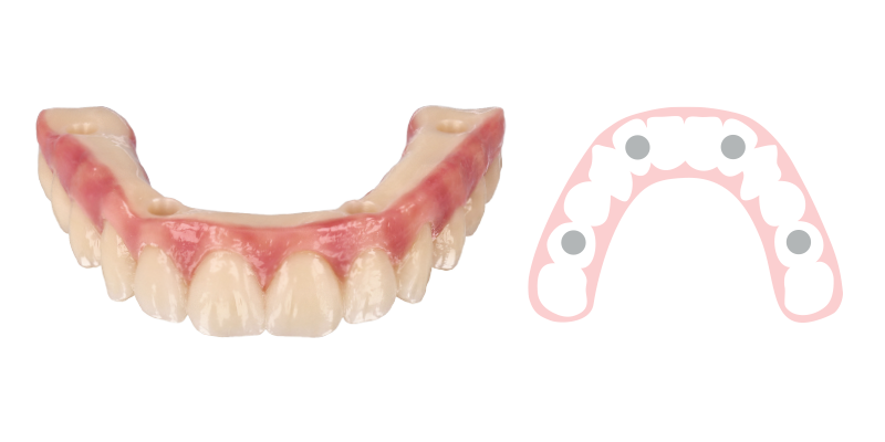 Zirconia Hybrid